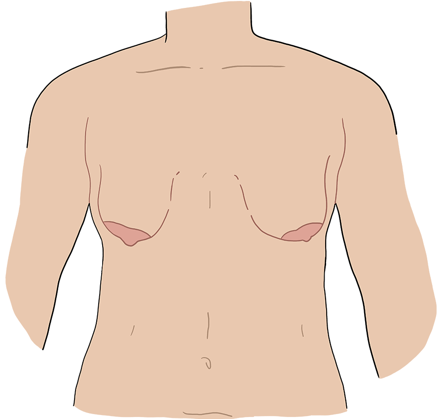 Illustration of a body with large downturned breasts.