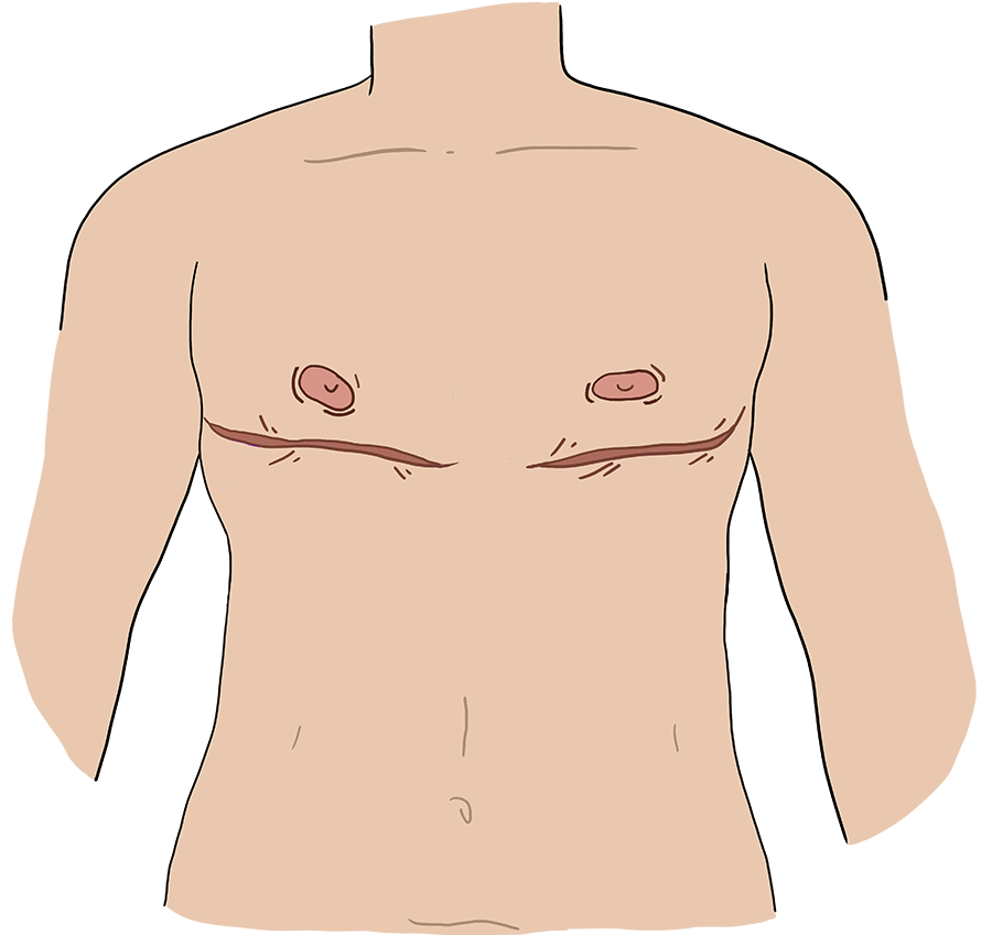 Illustration of the same body with post-operative scars in a long line below each areola/nipple.