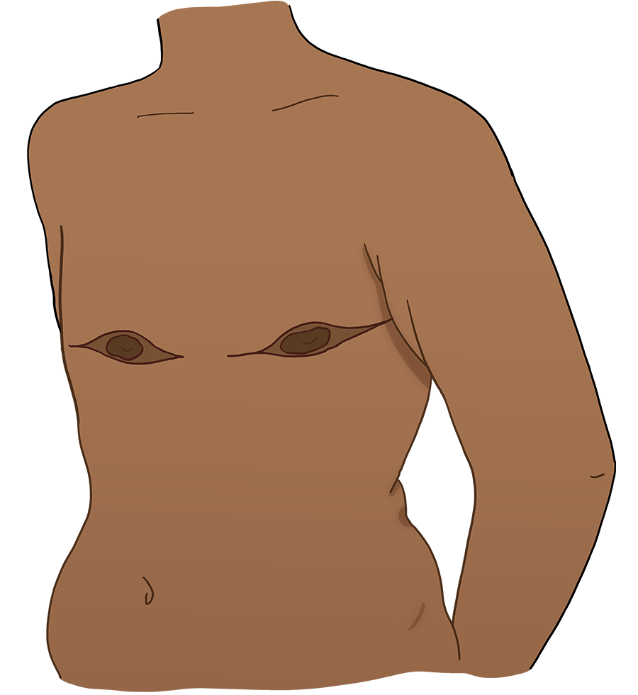 Illustration of the same body with post-operative scars in the shape of a fishmouth around the each areola.