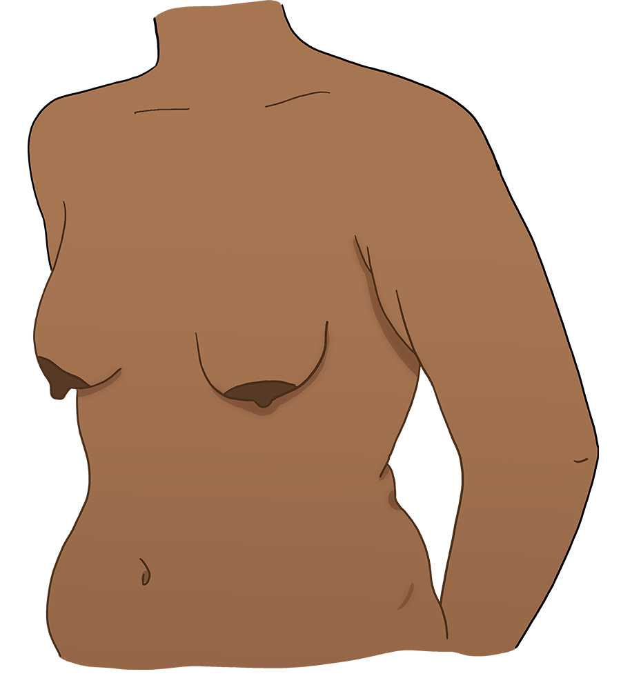 Illustration of a body with small breasts and large downturned areolas and nipples.