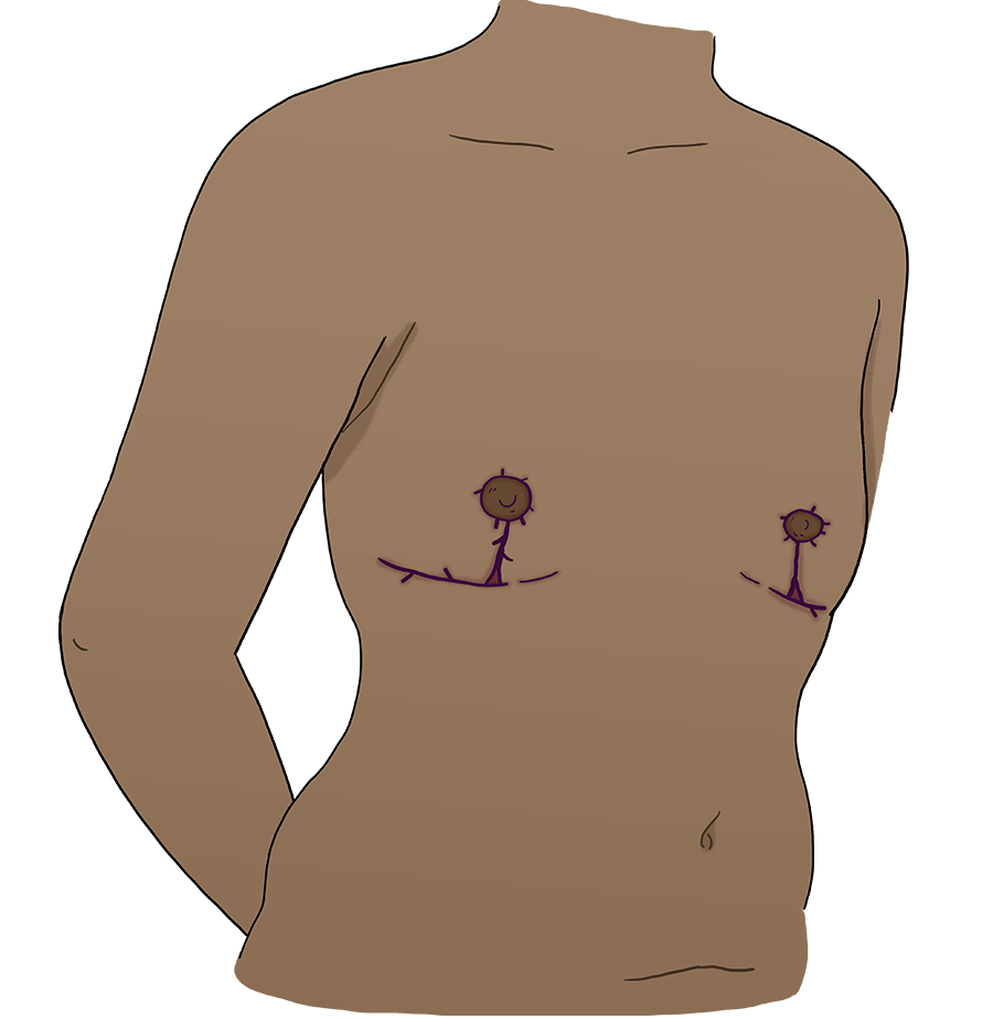 Illustration of the same body with post-operative scars in an inverted T shape centred below each areola.