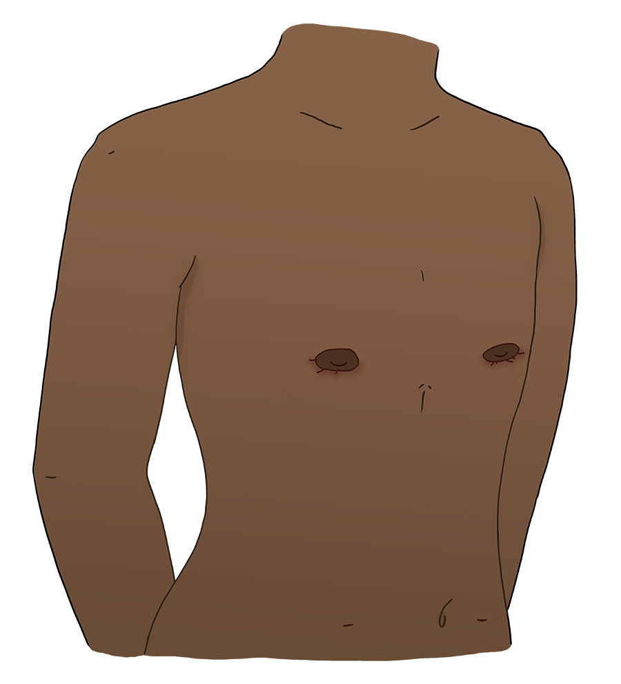 Illustration of the same body with post-operative for Keyhole surgery.