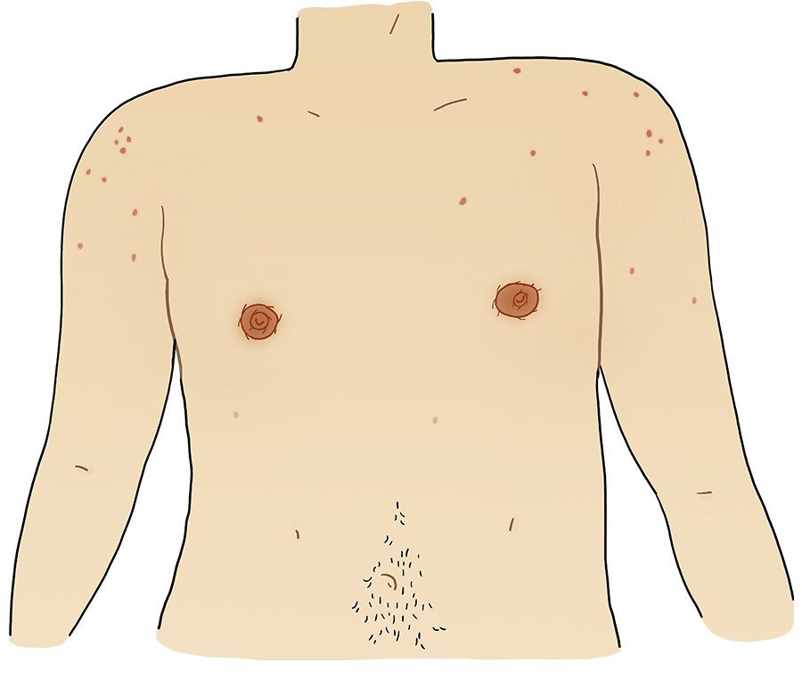 Illustration of the same body with post-operative scars around each areola.