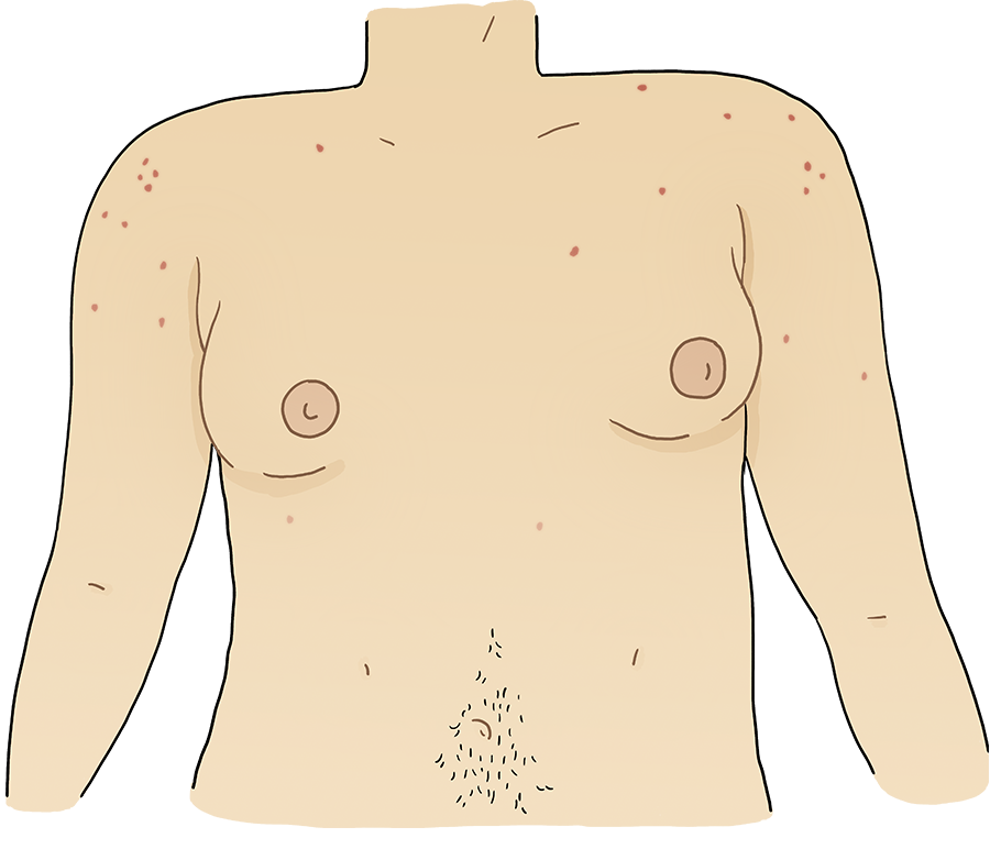 Illustration of chest with smaller breasts.